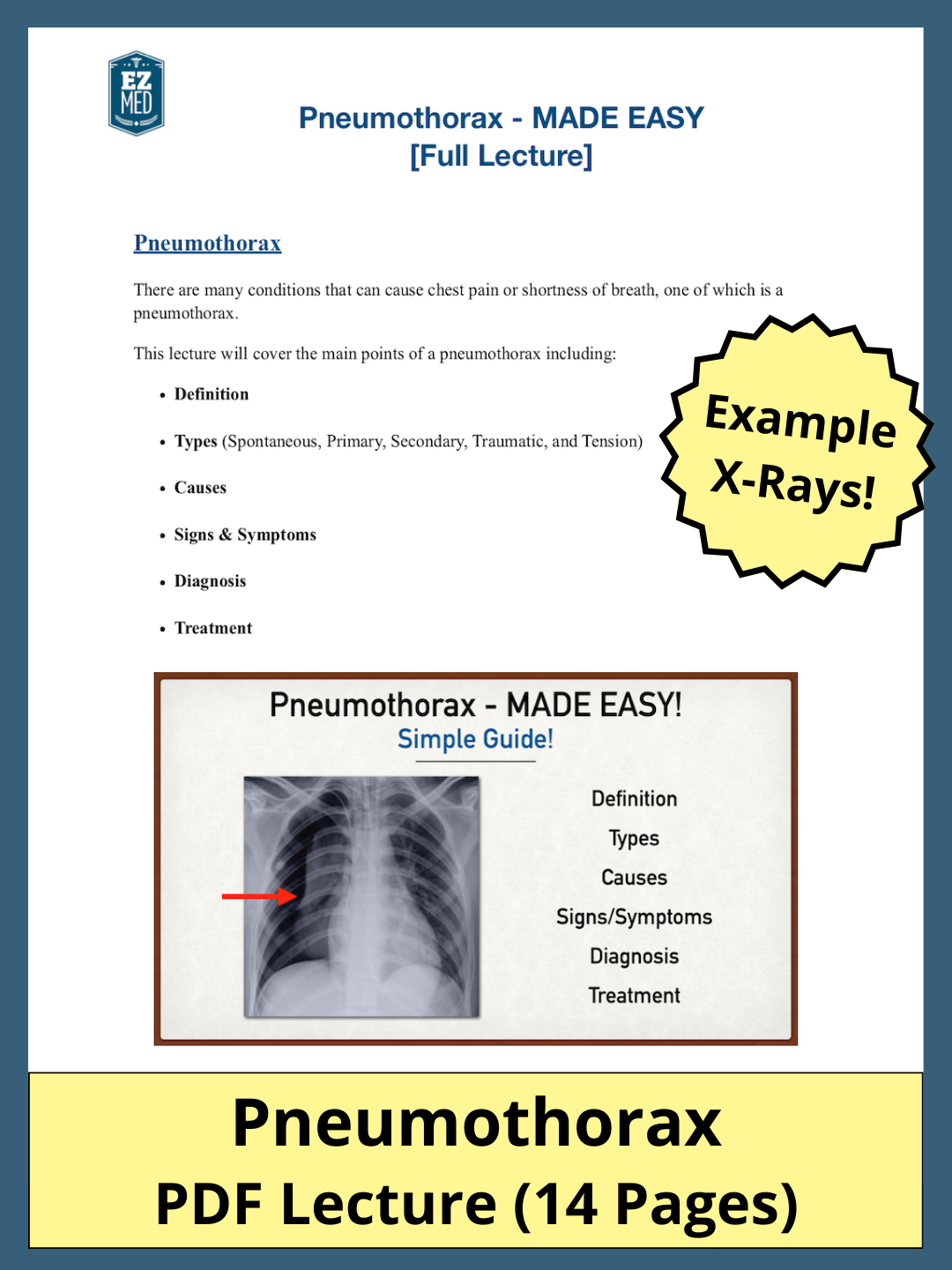 Pneumothorax [PDF Lecture]